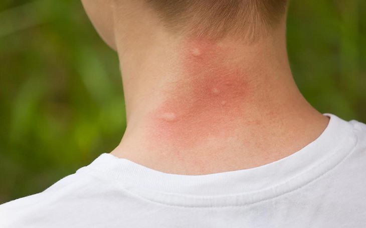 Côn trùng đốt có thể gây nguy hiểm và cách xử trí