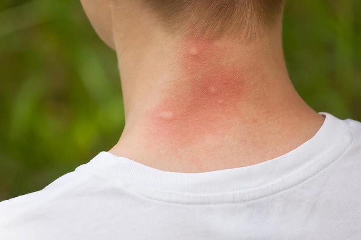 Bị côn trùng đốt có nguy hiểm? Cách xử trí và dùng thuốc như nào? - Ảnh 1.