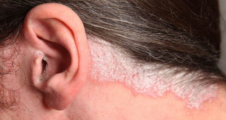Bệnh vẩy nến có lây không?  - Ảnh 1.