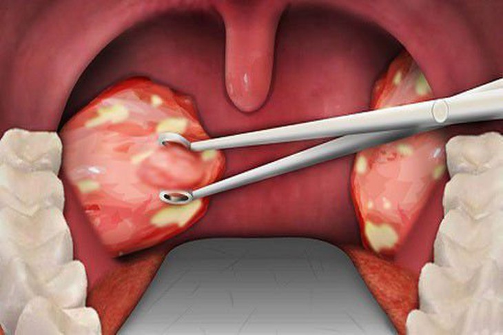 Amidan là những tế bào lympho để bảo vệ cơ thể chống lại sự xâm nhập của vi khuẩn. Ảnh minh họa