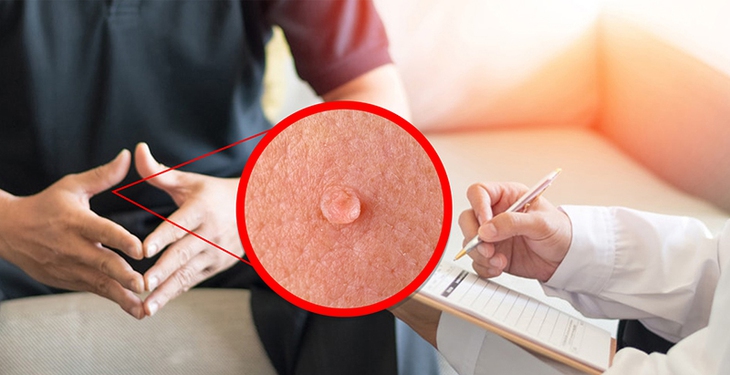 Hiện nay y học vẫn chưa tìm được thuốc chữa đặc trị cho bệnh mụn cóc sinh dục. Việc điều trị tùy thuộc vào tình trạng bệnh mỗi người. Ảnh minh họa