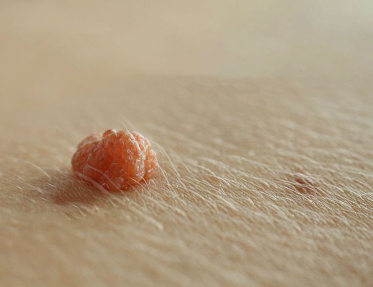 Mụn cóc sinh dục do vi rút gây u nhú ở người Human papilloma virus (HPV)gây bệnh, thường có thời gian ủ bệnh từ 1-8 tháng. Ảnh minh họa