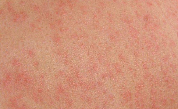 Mùa hè nổi mẩn đỏ, ngứa da cần xử trí như thế nào? - Ảnh 1.