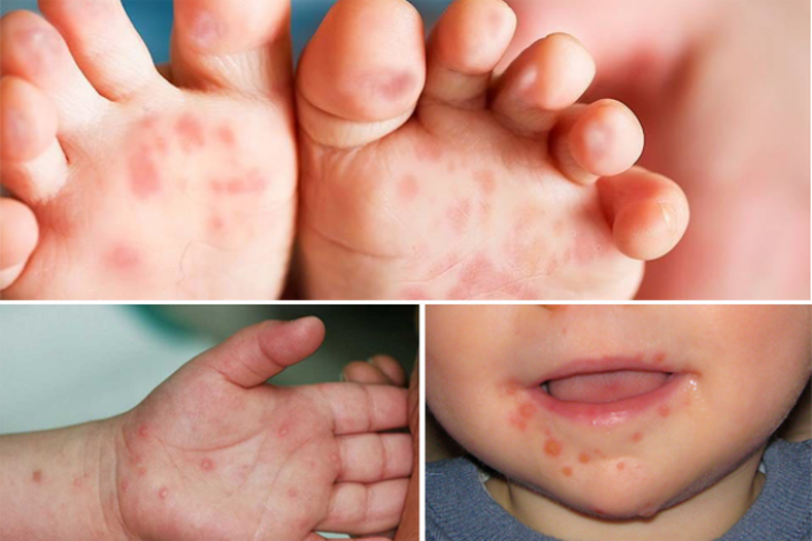 Trẻ mắc bệnh truyền nhiễm tăng, chuyên gia y tế khuyến cáo gì? - Ảnh 1. Trẻ mắc bệnh truyền nhiễm tăng, chuyên gia y tế khuyến cáo gì? - Ảnh 1.