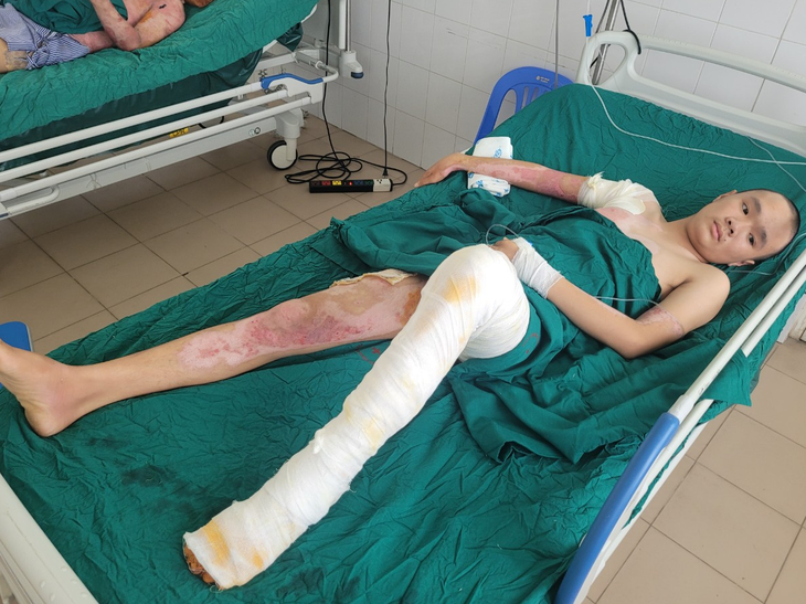 Gần 30 triệu đồng đến với cậu bé mồ côi cha bị bỏng nặng vì điện giật - Ảnh 1. Gần 30 triệu đồng đến với cậu bé mồ côi cha bị bỏng nặng vì điện giật - Ảnh 1.