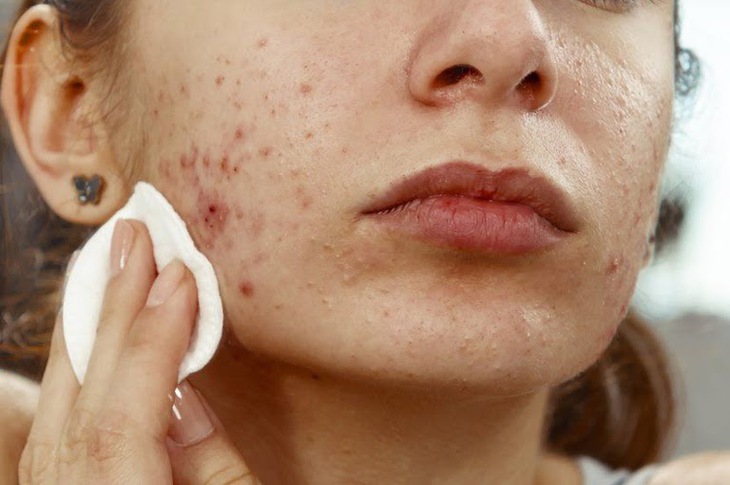 Cách chăm sóc da mụn trứng cá ngày hè - Ảnh 1. Cách chăm sóc da mụn trứng cá ngày hè - Ảnh 1.