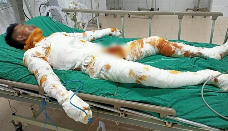 Xót xa người đàn ông bị điện giật bỏng nặng khi đi câu cá - Ảnh 1. Xót xa người đàn ông bị điện giật bỏng nặng khi đi câu cá - Ảnh 1.