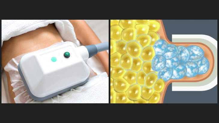 Điều trị Paradoxical Adipose Hyperplasia và loại bỏ phương pháp đông lạnh hủy mỡ Coolsculpting tại Bệnh viện AVA   - Ảnh 1.
