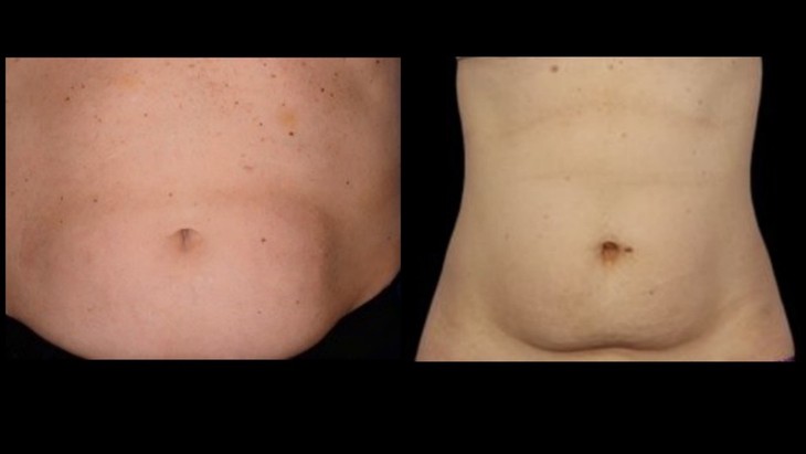 Điều trị Paradoxical Adipose Hyperplasia và loại bỏ phương pháp đông lạnh hủy mỡ Coolsculpting tại Bệnh viện AVA   - Ảnh 2.