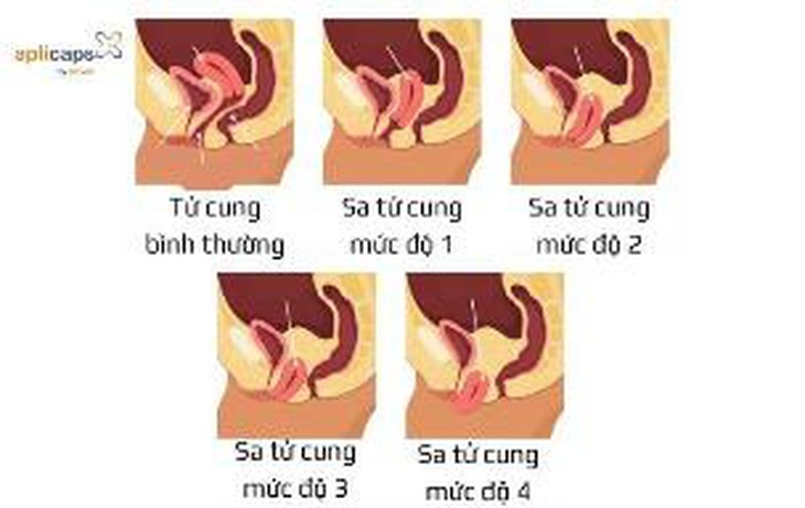 muc-do-sa-tu-cung-o-phu-nu-sau-sinh