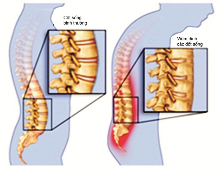 4 dấu hiệu của viêm cột sống dính khớp cần biết - Ảnh 1.
