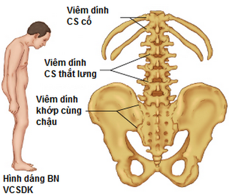 Viêm cột sống dính khớp có chữa khỏi không?- Ảnh 1.