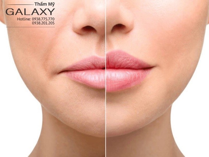 Tiêm filler môi đẹp chuẩn y khoa - Ảnh 2. Tiêm filler môi đẹp chuẩn y khoa - Ảnh 2.