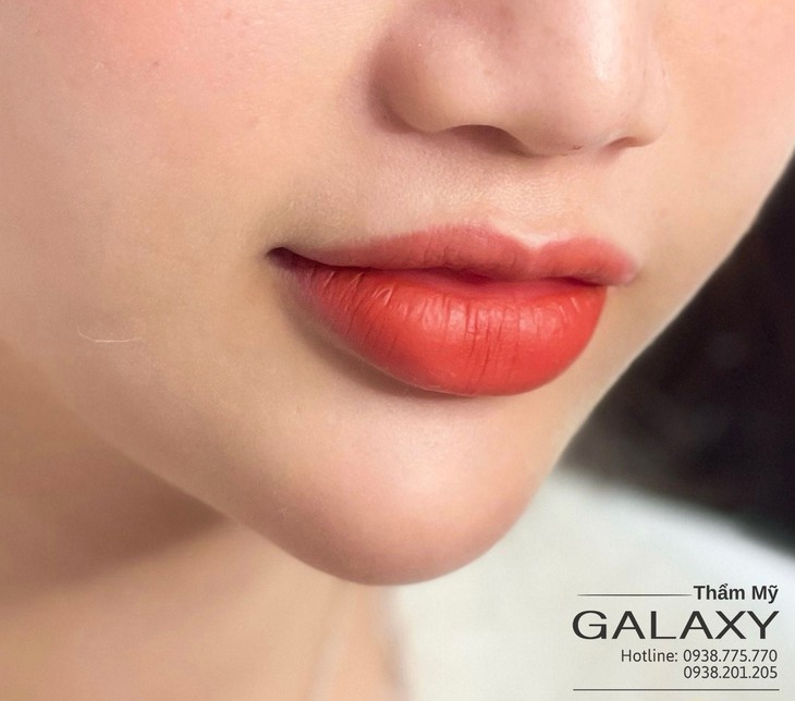 Tiêm filler môi đẹp chuẩn y khoa - Ảnh 3. Tiêm filler môi đẹp chuẩn y khoa - Ảnh 3.