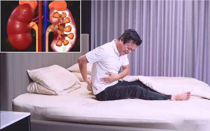 Hiểu rõ về sỏi thận để giảm nỗi lo