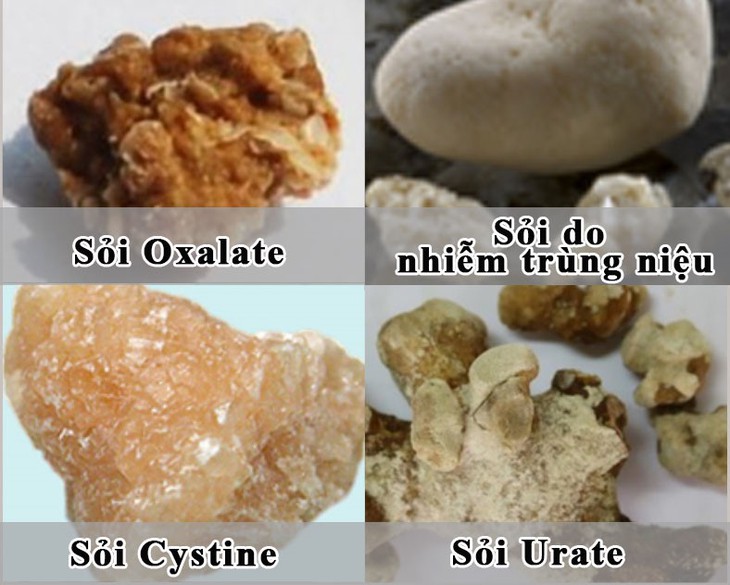 Hiểu rõ về sỏi thận để giảm nỗi lo - Ảnh 1. Hiểu rõ về sỏi thận để giảm nỗi lo - Ảnh 1.