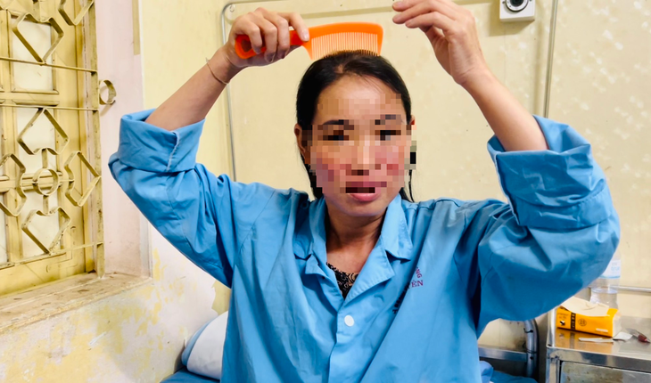 Mất tiền đi cấy tóc mới phát hiện bị Lupus ban đỏ - Ảnh 1.