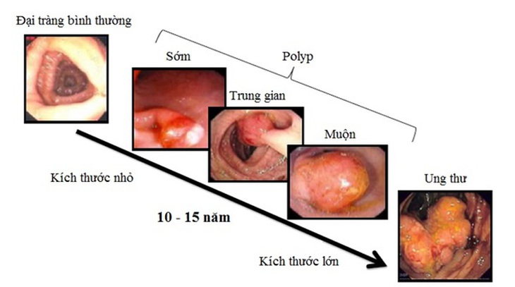 Ung thư đại tràng: Nguyên nhân, triệu chứng và điều trị - Ảnh 2.