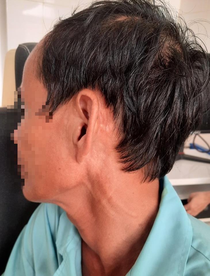 Đau tai dữ dội, đi khám phát hiện hàng chục con giòi đang làm tổ - Ảnh 2.