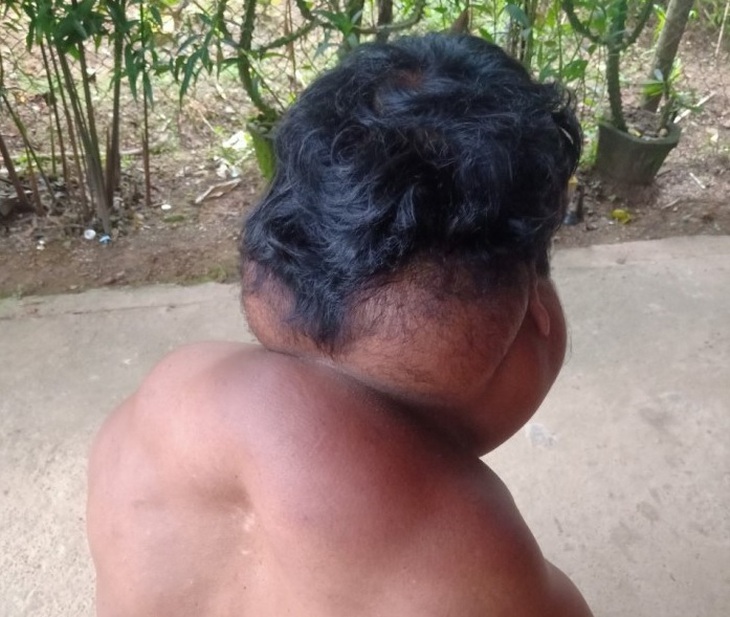 Giải thoát bệnh nhân khỏi các khối u lớn cùng cổ vai gáy do bệnh Madelung - Ảnh 1.