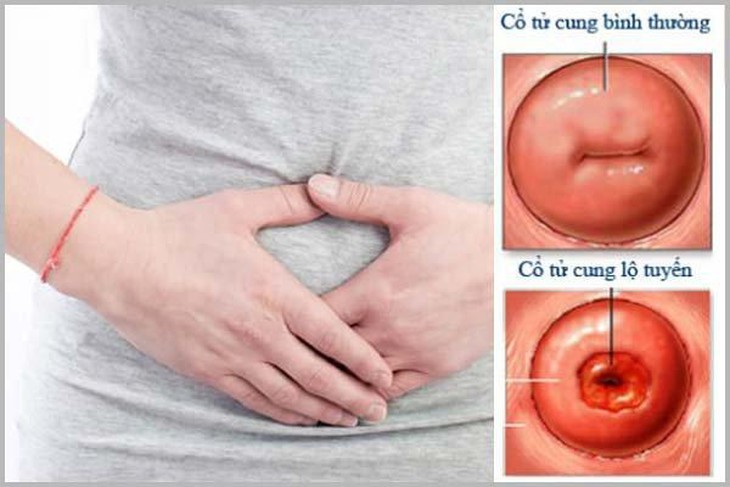 Khi phát hiện viêm lộ tuyến cổ tử cung ở độ 1, khả năng chữa khỏi rất cao. Còn nếu để tình trạng viêm nhiễm kéo dài, bệnh sẽ chuyển biến xấu hơn, có thể biến chứng thành ung thư cổ tử cung, gây vô sinh,... Ảnh minh hoạ
