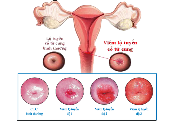 Viêm lộ tuyến tử cung được chia theo 3 cấp độ từ nhẹ đến nặng. Tùy vào các cấp dộ và nguyên nhân gây bệnh, các bác sĩ sẽ có liệu trình điều trị phù hợp. Ảnh minh hoạ