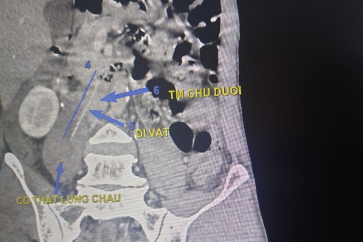 Thói quen nguy hiểm từ vụ nữ sinh lớp 11 thủng ruột do nuốt tăm - Ảnh 2. Thói quen nguy hiểm từ vụ nữ sinh lớp 11 thủng ruột do nuốt tăm - Ảnh 2.