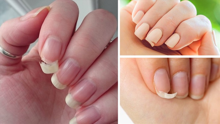 Móng tay giòn dễ gãy do đâu và cách khắc phục - Ảnh 1.