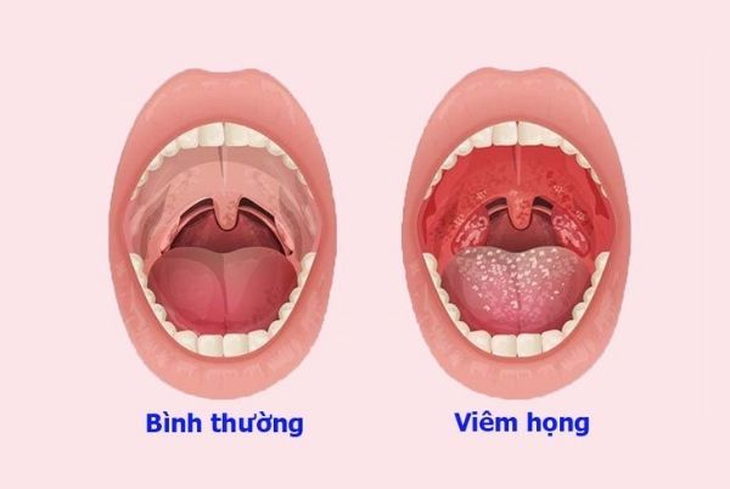 Đông y phòng và trị viêm họng mùa hè - Ảnh 1.