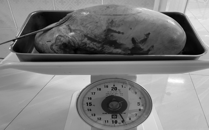 Bé gái 15 tuổi mang trong mình khối u nang buồng trứng "khủng" nặng 9kg - Ảnh 2. Bé gái 15 tuổi mang trong mình khối u nang buồng trứng "khủng" nặng 9kg - Ảnh 2.