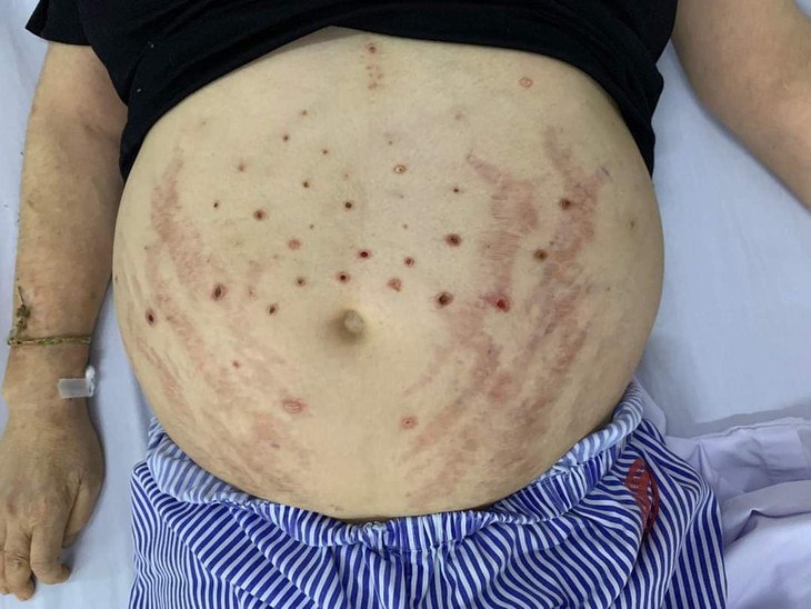 Nghe lời thầy lang chữa đau chân tay bằng cách cho ong đốt, bệnh nhân đái tháo đường gặp biến chứng - Ảnh 2.