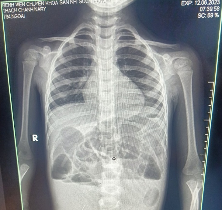 Phẫu thuật cấp cứu cho bé gái 4 tuổi bị tắc ruột do "ăn tóc" - Ảnh 1.