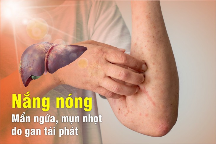 Xua tan nỗi lo mẩn ngứa, mụn nhọt do gan khi sang hè - Ảnh 1. Xua tan nỗi lo mẩn ngứa, mụn nhọt do gan khi sang hè - Ảnh 1.