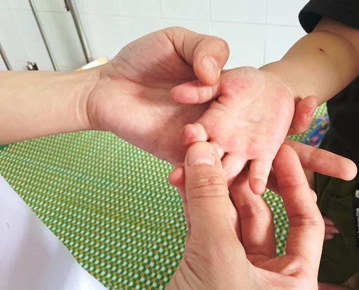 Quảng Nam yêu cầu sẵn sàng các đội cơ động điều trị bệnh tay chân miệng - Ảnh 1.
