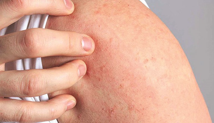 Dị ứng thức ăn thường phát triển trong vòng vài phút đến một giờ sau khi ăn. Ảnh minh họa