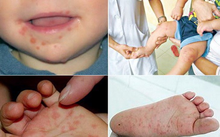 Thông tin mới nhất về bệnh tay chân miệng ở nước ta, 6 khuyến cáo cần nhớ của Bộ Y tế