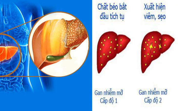 Tác hại khi gan nhiễm mỡ và cách hạn chế
