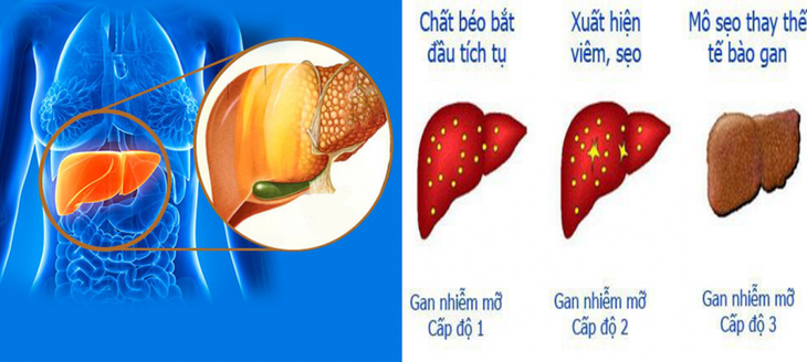 Cải thiện gan nhiễm mỡ hiệu quả tại nhà- Ảnh 1. Cải thiện gan nhiễm mỡ hiệu quả tại nhà- Ảnh 1.