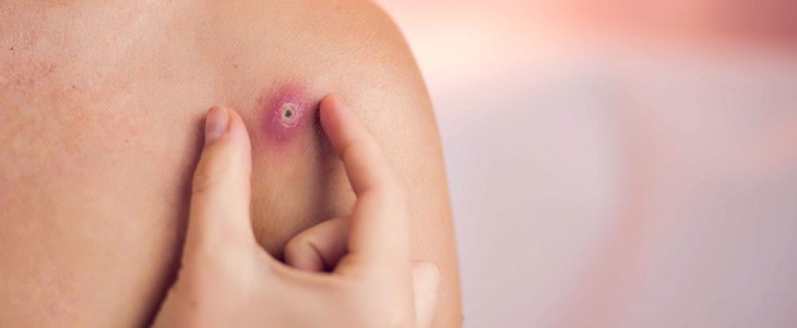 5 sai lầm thường gặp khi trị nhọt và cách xử trí - Ảnh 2.