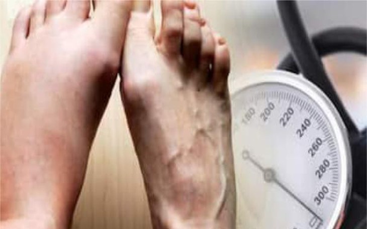 Dấu hiệu ở chân cảnh báo tăng huyết áp
