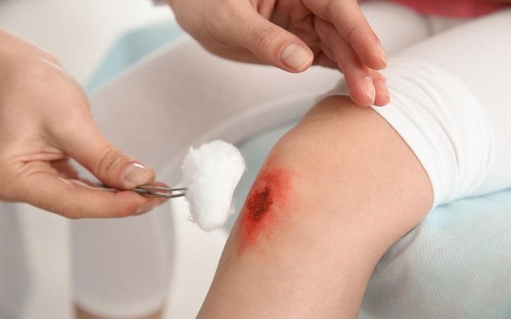 Bài thuốc cổ giúp giảm bầm tím, sưng đau, vết thương hở - Ảnh 2. Bài thuốc cổ giúp giảm bầm tím, sưng đau, vết thương hở - Ảnh 2.