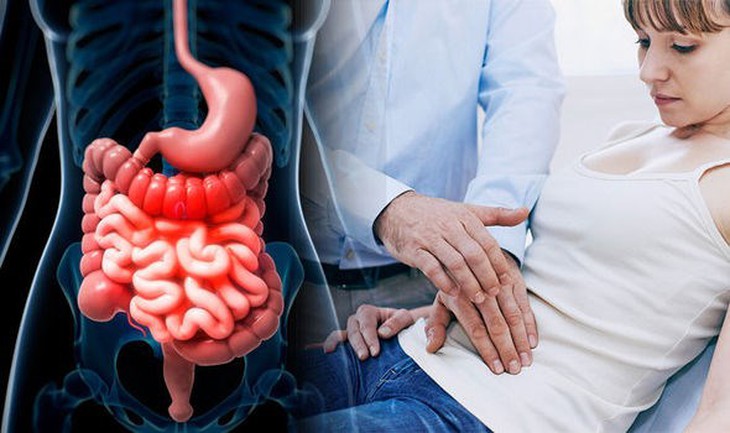 Hội chứng ruột kích thích (IBS) - Ảnh 3.