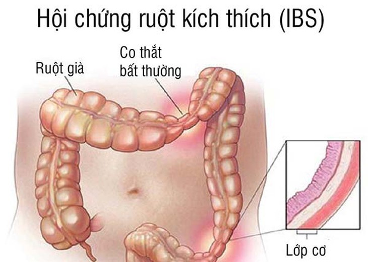 Hội chứng ruột kích thích là chức năng của ruột bị rối loạn mà chúng ta không quan sát thấy tổn thương bất thường trên nội soi hay chẩn đoán hình ảnh nào khác.