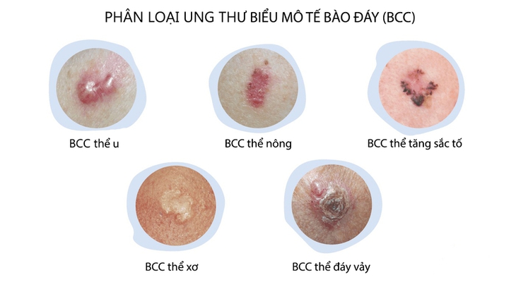 Ung thư da và những điều cần biết - Ảnh 1.