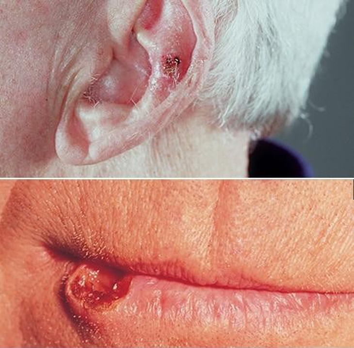 Ung thư da và những điều cần biết - Ảnh 2.