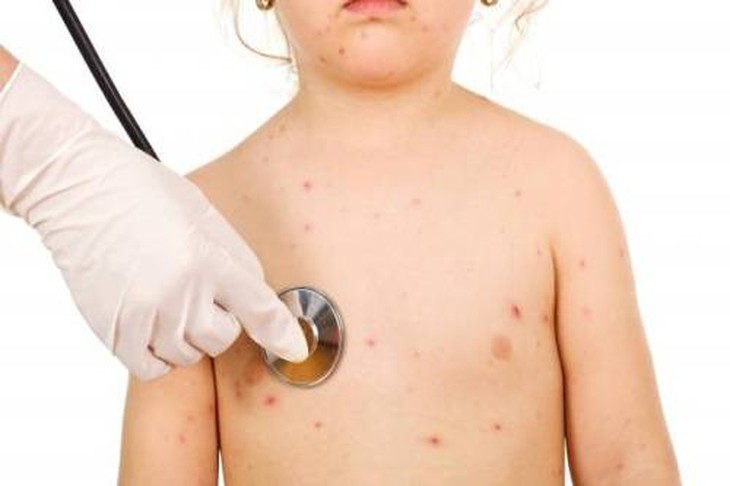 Nên chủ động phòng tránh thủy đậu để không lây lan và gây biến chứng - Ảnh 3.