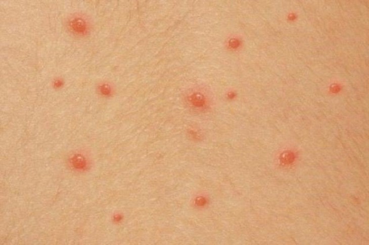 Bệnh thủy đậu lây truyền chủ yếu qua đường hô hấp. Ảnh minh họa
