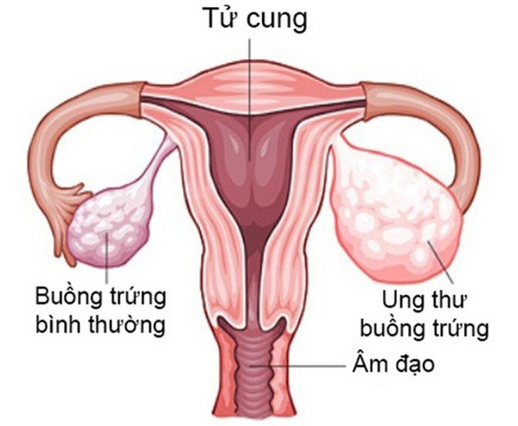 Nguy cơ ung thư buồng trứng sau khi cắt bỏ tử cung? - Ảnh 2. Nguy cơ ung thư buồng trứng sau khi cắt bỏ tử cung? - Ảnh 2.