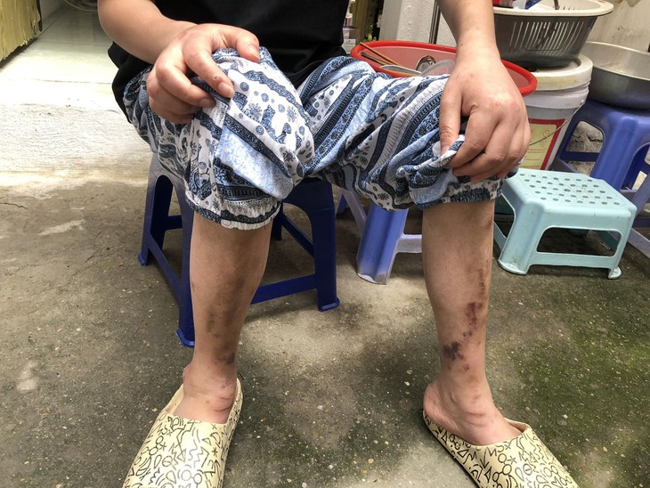 MS 854: Cuộc sống khốn cùng của cô gái mang đủ thứ bệnh trên người, nguy cơ hỏng hai mắt - Ảnh 4.