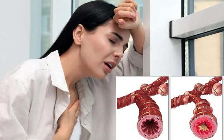 3 cách thông thoáng đường thở cho người hen phế quản